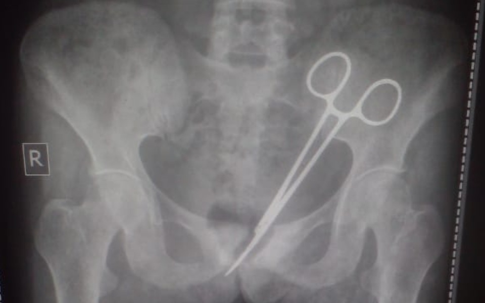 Scissors Removed from Woman’s Abdomen 12 Years After Surgery